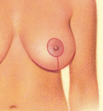 mammoplasty